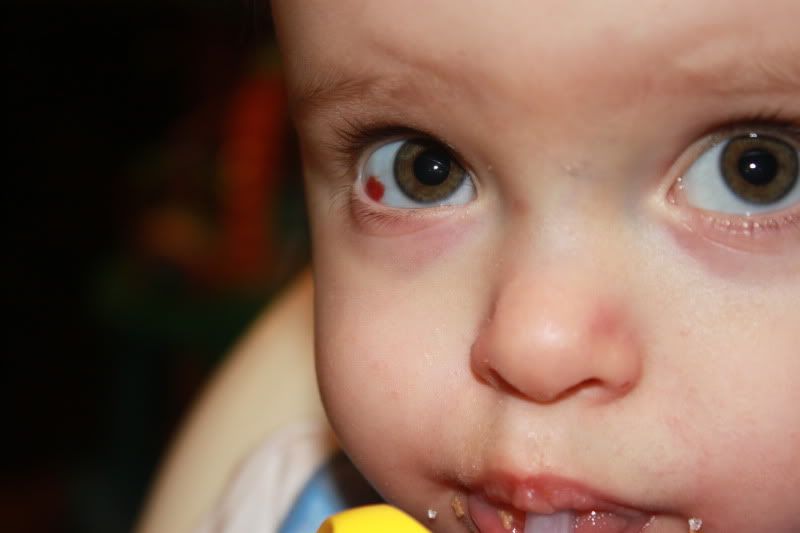 bloodshot eye??? BabyCenter